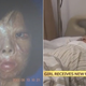 Illustration for article titled Burned Teen Grows New Face Parts on Her Chest (Warning: Graphic)